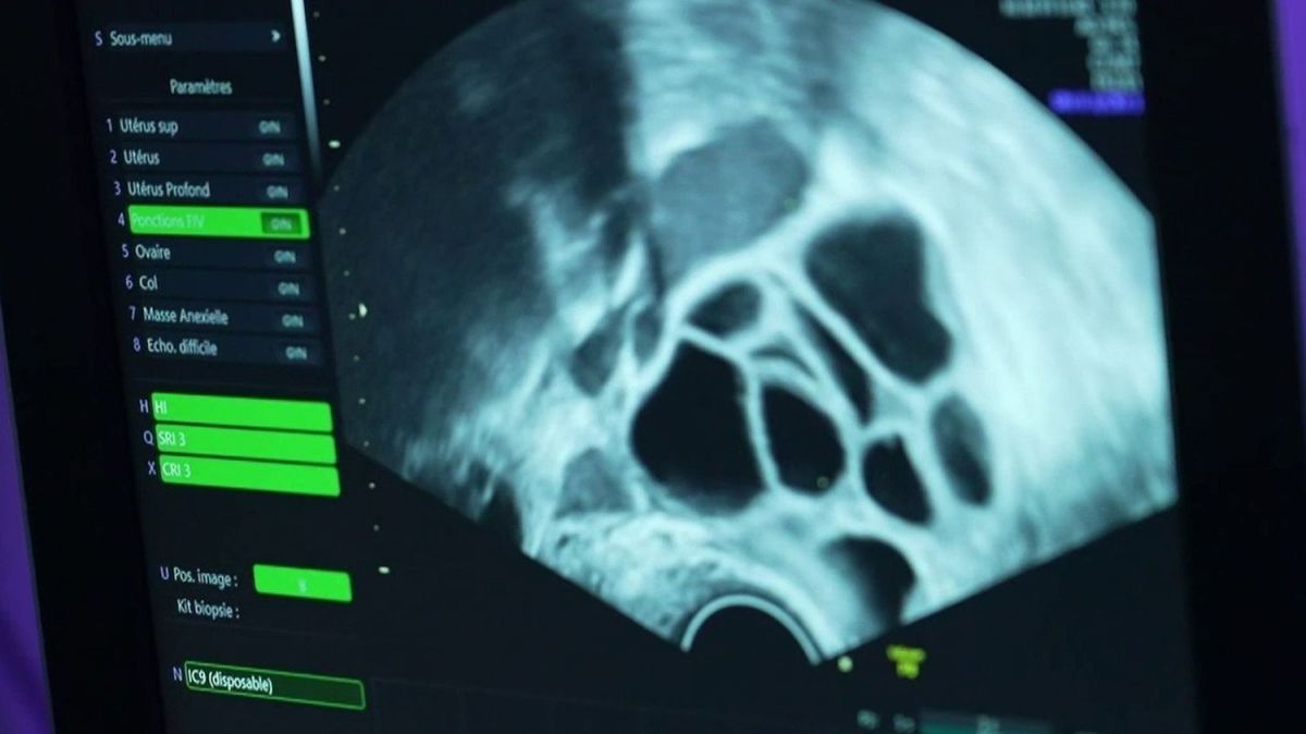 Congélation d'ovocytes : un enjeu croissant face à une maternité tardive en France